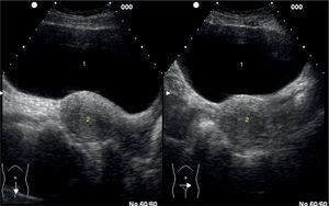 Corte longitudinal y transversal en el hipogastrio visualizando la vejiga (1) muy replecionada con el útero (2).