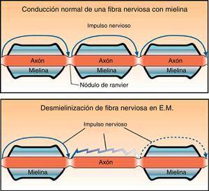 En este diagrama se aprecia la diferencia en la conducción nerviosa entre un axón mielínico (arriba) y uno con pérdida de mielina en la esclerosis múltiple (abajo).