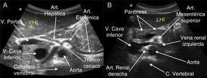 A. Corte transversal a nivel de epigastrio medio al nivel de la salida de la primera rama de la aorta abdominal, el tronco celíaco. Podemos observar cómo al poco de su salida el tronco celíaco se divide en la arteria esplénica (que discurre hacia la izquierda del paciente, en dirección al bazo) y la arteria hepática (que se dirige a la derecha del paciente, para formar parte junto con la vena porta y el colédoco de la tríada portal), esta bifurcación es la típica imagen de la «gaviota». B. Corte transversal a nivel de epigastrio inferior, justo en la zona de la pinza aorto-mesentérica, que se forma por el espacio que existe entre la arteria mesentérica superior y la aorta, y por la que discurre la vena renal izquierda en su recorrido hacia la vena cava inferior, que se encuentra a la derecha de la columna vertebral. También podemos ver en esta imagen el páncreas (cabeza, istmo, cuerpo y cola), un corte de través de la arteria mesentérica superior (rodeada de un halo hiperecogénico, lo que la hace resaltar más) y el nacimiento de la arteria renal derecha, que se dirige hacia el riñón derecho, pero pasando por detrás de la cava inferior.