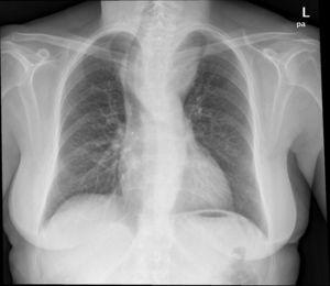 Radiografía de tórax donde se aprecia aumento mediastínico por bocio intratorácico.