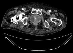 Imagen de TAC pélvica donde se observa una próstata aumentada de tamaño, con extensas colecciones líquidas en ambos lóbulos y algún foco cálcico.
