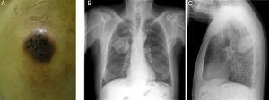 A) Lesión metastásica en región escapular derecha. Radiografía de tórax posteroanterior (B) y lateral (C).