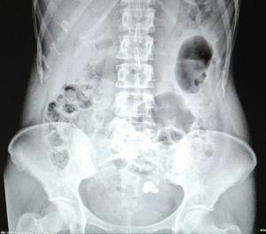 Radiografía de abdomen.