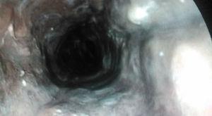 Imagen endoscópica de esófago proximal y distal donde se observa mucosa con un tono parduzco con exudados algodonosos tapizando toda la circunferencia esofágica.
