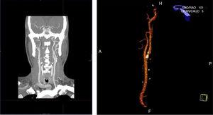 Imagen de angio-TAC de placa de ateroma en carótida interna derecha que provoca una estenosis del 70%.