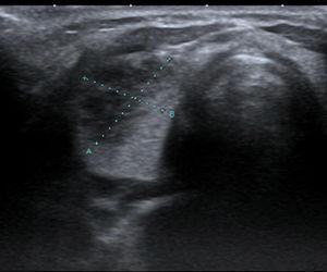 Corte transversal de lóbulo tiroideo derecho, donde se observa una zona hipoecogénica, de bordes mal definidos, de 15×11mm.