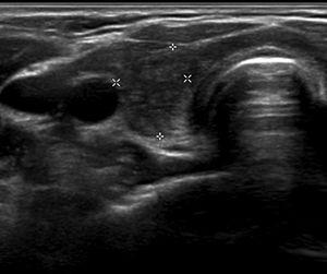 Ecografía de control a los 2 meses del inicio del tratamiento. Corte transversal de lóbulo tiroideo derecho, que presenta disminución difusa de la ecogenicidad, sin lesiones nodulares diferenciadas.