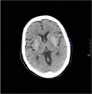 Imagen de tomografía axial computarizada (TAC) cerebral que muestra un aumento simétrico de la densidad putaminal sin relevancia clínica.