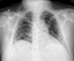 Radiografía posteroanterior de tórax. Imagen compatible con neumonía bilateral por COVID-19.