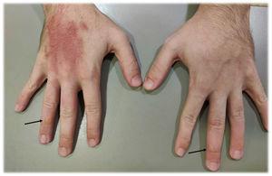 Erupción eritemato-edematosa de bordes bien delimitados localizada en el dorso de la mano derecha y ampollas tensas de contenido seroso en los dedos (flechas).