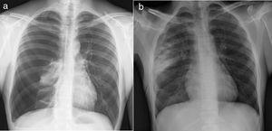 a) Radiografía de tórax con neumotórax masivo derecho asociado a colapso del pulmón derecho; b) Radiografía de tórax de control, que muestra reexpansión del pulmón derecho con infiltrado en el lóbulo superior (b).