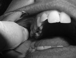 Imagen de la palpación de la zona yugal derecha en la cara interna de la rama mandibular, a la que llamamos «zona del CAT».