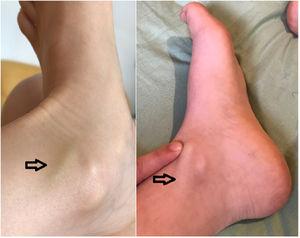 Imagen de miembro inferior derecho en el momento del diagnóstico (derecha) y tras varios días de tratamiento (izquierda). Obsérvese el cordón venoso (flecha).