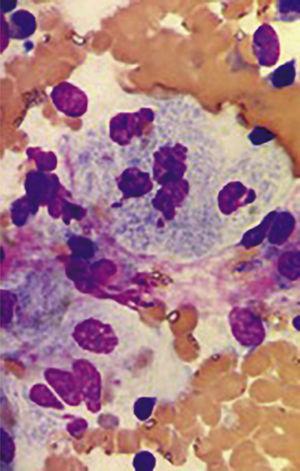 Aspirado de medula ósea con hipercelularidad a expensas de histiocitos, “células espumosas”; tinción de hematoxilina y eosina, las células violeta corresponden a elementos celulares de la médula ósea, en rosa claro corresponden a lípidos complejos en el lisosoma celular; micrografía 50X