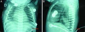 A) Anterior-posterior thoracic X-ray evidencing cardiomegaly. B) Lateral thoracic X-ray evidencing cardiomegaly.