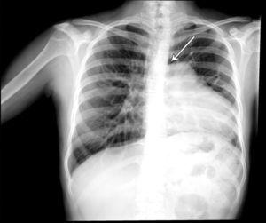 Telerradiografía de tórax donde se observa elevación del hemidiafragma izquierdo asociado a pérdida de volumen pulmonar. Silueta cardiaca desplazada a la izquierda. Tráquea desplazada a la derecha. Cono de la arteria pulmonar prominente. Rama pulmonar derecha dilatada. Flujo pulmonar aumentado. La flecha indica un área lúcida entre la aorta y el cono de la pulmonar debido a la interposición del pulmón.