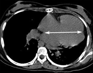 Tomografía en el plano axial a nivel de las cavidades ventriculares con ausencia de pericardio. La flecha indica el desplazamiento cardiaco a la izquierda.