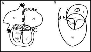 Forma de transición anatomoembriológica entre defecto de la tabicación con 2 válvulas en el cual las valvas septales de la válvula atrioventricular izquierda sellaron casi en su totalidad la comunicación interventricular situada cerca de la aorta. Esquemas del corazón: A) vista frontal de 4 cámaras. B) vista lateral izquierda. 1: foramen primum; 2: foramen secundum; AD: aurícula derecha; AI: aurícula izquierda; CIV: comunicación interventricular; VD: ventrículo derecho; VI:ventrículo izquierdo.