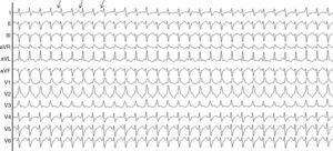 12-lead ECG. Wide complex tachycardia (QRS 105ms, heart rate, 167beats per minute) with right bundle branch block morphology in the horizontal plane and left superior axial deviation in the frontal plane. Posterior fascicular ventricular tachycardia based on atrioventricular dissociation (arrows).