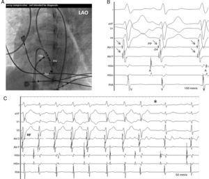 (A) Electrograms during VT showing recordings from distal to proximal sites (LV1–2, LV9–10) of decapolar mapping catheter located along the left ventricular septum. Earliest Purkinje potential (PP, arrows) was recorded at apical sites and activation sequence was toward the basal sites (long dotted arrow). (B) Fluoroscopic view showing catheter electrode positions. I, aVF, V1, V5 ECG leads; HIS; His bundle; RV, right ventricle; LAO, left anterior oblique.