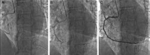 (A) Predilatation with a semi-compliant balloon. (B) Stent implantation was enabled by the deep seating of the Guideliner. (C) The final angiographic result.