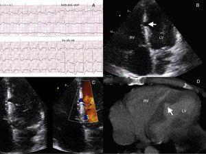 (a) superficie ECG che mostra un diritto completo Branch Bundle Block. (B) Ecocardiografia (vista apicale da 4 camere) che visualizza una rottura incompleta del setto interventricolare (freccia) sul lato sinistro. (C) Zoomed 2D e colore Doppler Doppler Visualizzazioni di imaging che non rivelano uno shunt tra il ventricolo sinistro (LV) e il ventricolo destro (RV). (D) Vista ravvicinata del cuore sulla scansione del torace CT che rivela un setto interventricolare della lacerazione del setto (freccia) notato in una seconda revisione della scansione.