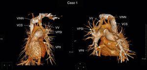 Caso 1: imágenes anterior y posterior de conexión anómala parcial de venas pulmonares izquierdas mixta. AI: aurícula izquierda; AP: arteria pulmonar; SC: seno coronario; VCS: vena cava superior; VINN: vena innominada; VPII: vena pulmonar inferior izquierda; VPSI: vena pulmonar superior izquierda; VV: vena vertical.