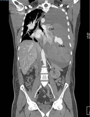 CT angiography in which a left massive hemothorax displaces the mediastinal structures to the contralateral side. An aneurysmal image and extravasation of the contrast media are observed in the left hemithorax. CM, contrast media; PAA, pulmonary artery aneurysm.