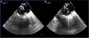 A y B: ecocardiograma transesofágico. En aorta ascendente se observan algunas placas ateroscleróticas. Se observa trombo de 2×1.2mm sobre placa aterosclerótica a nivel del final del cayado aórtico a 15-20cm de la arcada dentaria. El trombo tiene varias excrecencias, alguna muy móvil.