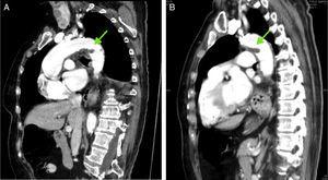 A y B: tomografía computarizada torácica. Muestra imagen circular que corresponde a restos de trombo a nivel aórtico, porción final del cayado aórtico cercano a la salida de la subclavia izquierda y donde no se aprecia trombo a nivel de aorta ascendente.
