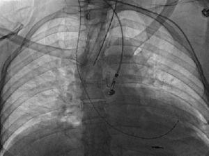 Imagen final después del retiro del sistema, quedando solo la punta del electrodo ventricular alojada en el ventrículo derecho.