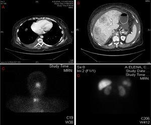 A-B: Imagen de tomografía computarizada. Figura 2A: a nivel de tórax con derrame pleural derecho. Figura 2B: a nivel abdominal, hígado con múltiples imágenes de metástasis y ascitis. Figuras 2 C-D: imagen de octreoscan en el que se evidencia captación patológica en cornete nasal izquierdo y lóbulo tiroideo derecho. Figura 2C: adenopatías hiliares pulmonares. Figura 2D: focos hipercaptantes asociados a sobreexpresión de receptores de somatostatina en hígado.