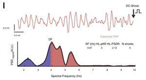 Representative VF recording and spectral-derived predictive variables. Upper panel, digitized tracing before the first DC shock. Lower panel, representative spectrum of the VF signal. Blue-filled and red-filled spectra show low (1.5–3.9Hz) and high spectral bands (3.9–10Hz), respectively. The DF peak (3.97Hz), HL-PSDR (2.12), HL-pKR (3) and the number of shocks delivered before RoSC (5) correctly classified such a case within low risk of non-favorable neurological performance. DF: dominant frequency; FNP: favorable neurological performance; HLPSDR: high-to-low power spectral density ratio; HL-pKR: high-to-low peak ratio; RoSC: return of spontaneous circulation; VF: ventricular fibrillation. Reproduced from Filgueiras-Rama et al.12 with permission of the publisher.