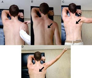 Prone: Making I, T, Y letters. Exercise starts with the individual lying in prone with arm hanging off the edge of the treatment table (A). Position the scapula in retraction and depression. The therapist can provide feedback with hands. Maintain this position while extending the arm posteriorly in line with the trunk (letter “I”, B), horizontally abducting the arm (letter “T”, C) or elevating the arm to about 120° (letter “Y”, D). Avoid activity of the upper trapezius. The black arrows indicate the importance of maintaining relative scapular retraction and depression during the exercise.