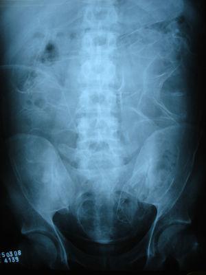 Abdominal radiograph showed marked peritoneal fibrosis outlining bowel loops.