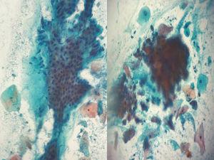 Normal (left) and atypical squamous cells of undetermined significance in anal cytology (right).