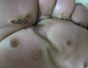 Multiple yellowish-brown papules and nodules affecting the interdigital spaces and the sole of the left foot.
