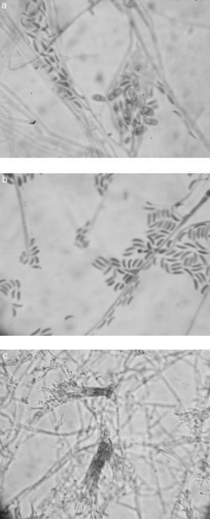 Microscopic morphology of Graphium basitruncatum from a 10-day old, 28°C potato dextrose agar slide culture demonstrating distinctive microscopic features included hyphae in prominent fascicles, “sausage shaped” or curved (allantoid), hyaline conidia with truncate bases (2.5–5.0mm long by 1.5–2.5mm wide) borne from single annellated conidiogenous cells (A and B) (1000×) or similarly in dark, prominent synnemata (C) (200×), and larger, brown, oval conidia (4–6.5mm long and 3–4mm wide) (A) (1000×).