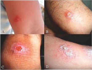 Lesions of patients with Old-World zoonotic cutaneous leishmaniasis caused by Leishmania major in Abarkouh District, Central Iran. A, primary nodule formation; B, classic wet-lesion; C, classic wet-lesion (typical); D, non-classic wet-lesion.