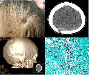 (A) External aspect of the scalp and skull lesion in an HIV-infected patient with chronic skull osteomyelitis due to Cryptococcus neoformans; (B) computed tomography scan of the patient's skull at admission showing paramenyngeal reaction with osteolytic parieto-occipital erosion; (C) three-dimensional reconstruction of the cranial lesion; (D) Grocott-Gomori methenamine-silver stain showing fungal structures compatible with Cryptococcus.