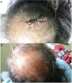 (A) One-week post-operative wound after surgical debridement of chronic skull osteomyelitis in an HIV-infected patient. (B) Three-week post-operative wound aspect.