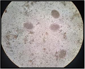 Stool examination by rapid sedimentation of Lumbreras showed hookworm eggs and few adult parasites.