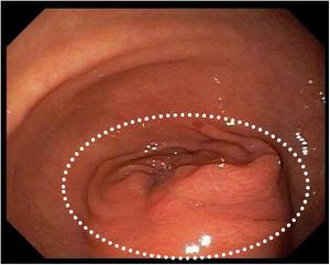 Infiltrative submucosal gastric neoplasm in the pylorus (circle).