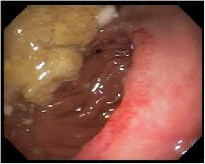 Post-operative control: gastroenteric anastomosis with no lesion or gastric food residue.