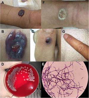 Human cutaneous anthrax in Patient 1. A–B) Severe edema on the right forearm, with multiple bullae and a centrally located black hemorrhagic eschar; C) blisters on the dorsal and proximal sides of the index finger; D) gray-white rough colonies grown on blood agar medium for 24h after smear of the discharge fluid; E) blood cultures were positive and identified as Bacillus anthracis; F–G) regression of the skin lesion after penicillin treatment.