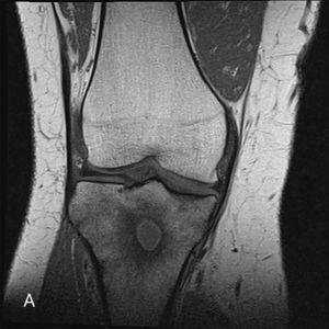 “Penumbra sign” of Brodie's abscess | The Brazilian Journal of ...