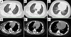 Normal chest CT findings at different sections: A and D, B and E, and C and F represent the same levels.