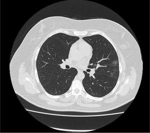 Chest computed tomography (CT) image in first day of hospitalization. The image demonstrates two ground glass opacities in peripheral area of left upper lobe. The patient had few bilateral, peripheral ground glass opacities.