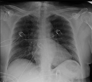 Chest X-ray with peripheral opacities in inferior lobes of both lungs.