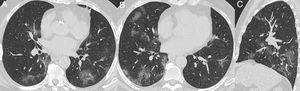 Nonenhanced high-resolution chest CT of a 79-year-old man presented with 7-day history of dyspnea, adynamia and COVID-19 exposure (wife and job colleague diagnosed with SARS-CoV-2 pneumonia). A and B, axial, C, sagittal chest CT shows a typical appearance, with bilateral and rounded ground-glass opacities with predominant peripheral distribution. The diagnosis of COVID-19 pneumonia couldn't be ruled out, even though with two negative RT-PCR. The patient had no alternative diagnosis during hospitalization and he obtained complete resolution mptoms and CT findings in a 6-month follow-up visit.
